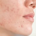 Rolling Scars: Understanding and Treating this Common Type of Acne Scarring