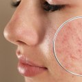 Understanding Whiteheads: Causes, Treatment, and Prevention