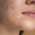 Understanding Ice Pick Scars and How to Treat Them