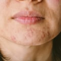Understanding the Connection Between Menopause and Acne