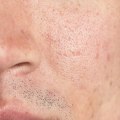 Understanding Boxcar Scars: Causes, Treatments, and Prevention