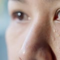 Milia: Understanding Non-Inflammatory Acne