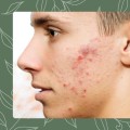 Understanding the Different Types and Causes of Acne