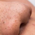 Understanding Blackheads: Causes, Treatment Options, and Prevention