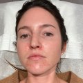 The Benefits and Uses of Chemical Peels for Acne Treatment