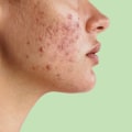Understanding Hormonal Changes and Their Impact on Acne
