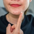 Benzoyl Peroxide: Understanding Acne Treatment Options