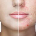 Exploring the Relationship Between Diet and Lifestyle Factors and Acne