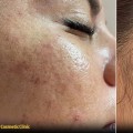 Understanding Chemical Peels for Acne Treatment