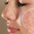 Understanding Isotretinoin (Accutane)