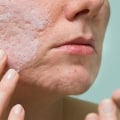 Understanding Salicylic Acid for Acne Treatment