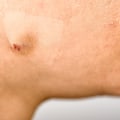Understanding Cysts: Causes, Treatment Options, and Prevention