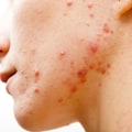 Understanding Antibiotics and Their Role in Acne Treatment
