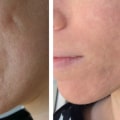 Understanding Laser Therapy for Acne Treatment