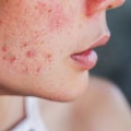 Polycystic Ovary Syndrome: Understanding Hormonal Imbalances and Acne