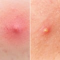 Understanding Pustules: A Comprehensive Guide to Inflammatory Acne
