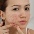 Understanding Puberty and Menstruation: A Comprehensive Guide for Managing Acne
