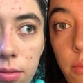 Retinoids: A Comprehensive Guide to Acne Treatment