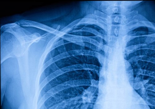Understanding Nodules: Causes, Treatment Options, and Prevention