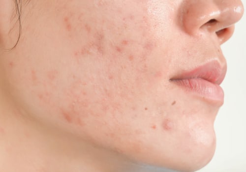 Rolling Scars: Understanding and Treating this Common Type of Acne Scarring