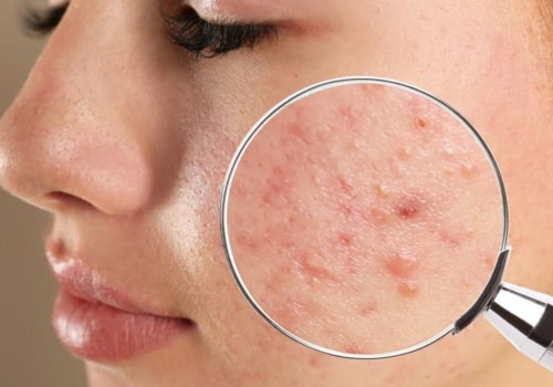 Understanding Whiteheads: Causes, Treatment, and Prevention