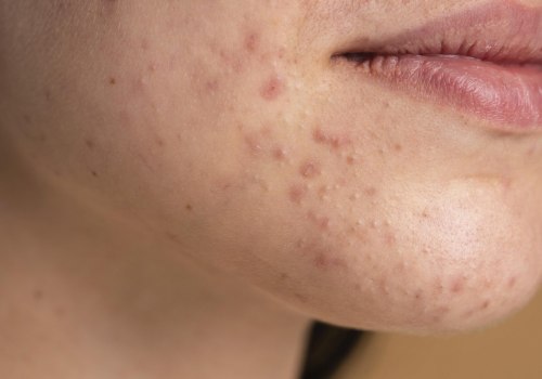 Understanding Ice Pick Scars and How to Treat Them