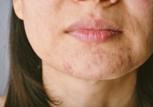 Understanding the Connection Between Menopause and Acne
