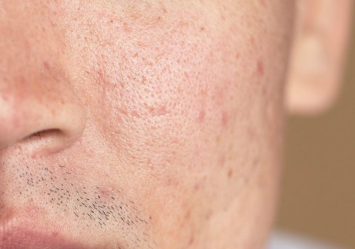 Understanding Boxcar Scars: Causes, Treatments, and Prevention