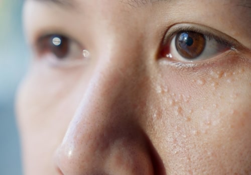 Milia: Understanding Non-Inflammatory Acne