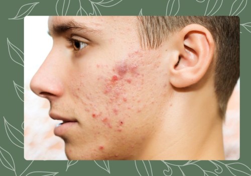Understanding the Different Types and Causes of Acne