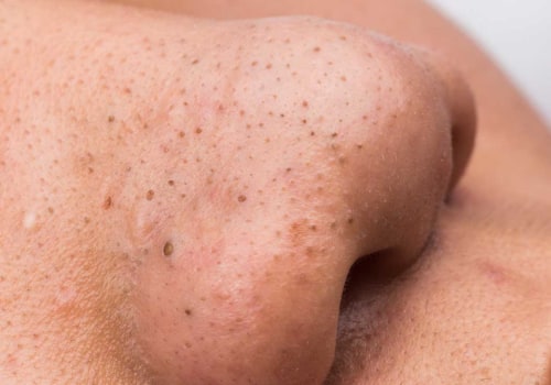 Understanding Blackheads: Causes, Treatment Options, and Prevention