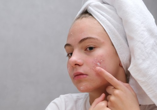 Avoiding Harsh Scrubbing: The Ultimate Guide to Skincare for Acne-Prone Skin
