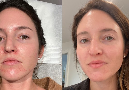 The Benefits and Uses of Chemical Peels for Acne Treatment