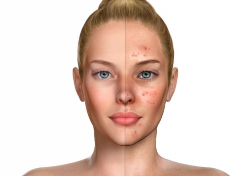 Preventing and Managing Breakouts: A Comprehensive Guide to Stress Management