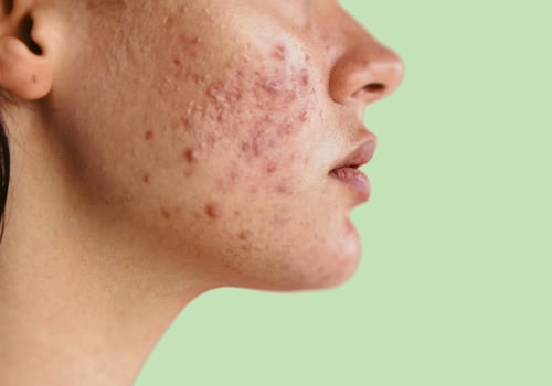 Understanding Hormonal Changes and Their Impact on Acne