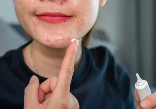 Benzoyl Peroxide: Understanding Acne Treatment Options