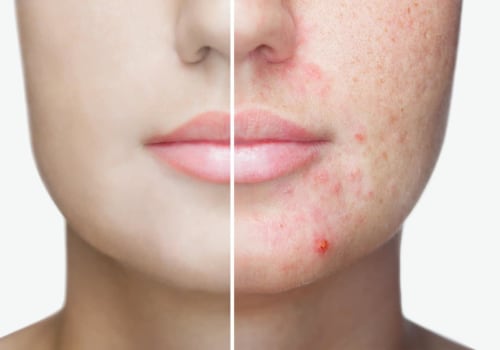 Exploring the Relationship Between Diet and Lifestyle Factors and Acne