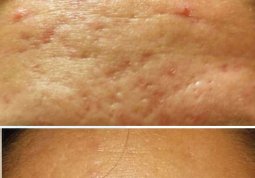 Exploring the Benefits of Microneedling for Acne Treatment