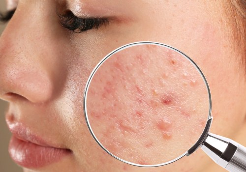Understanding Isotretinoin (Accutane)