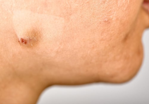 Understanding Cysts: Causes, Treatment Options, and Prevention