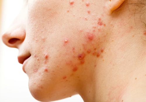 Understanding Antibiotics and Their Role in Acne Treatment