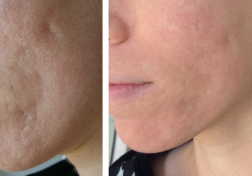 Understanding Laser Therapy for Acne Treatment