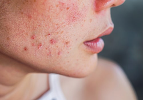 Polycystic Ovary Syndrome: Understanding Hormonal Imbalances and Acne
