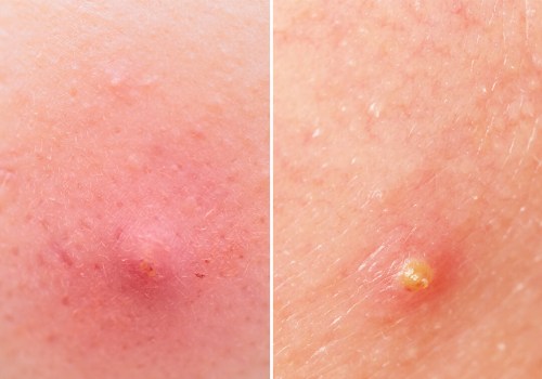 Understanding Pustules: A Comprehensive Guide to Inflammatory Acne