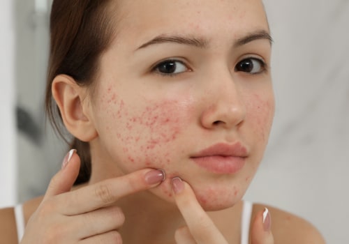 Understanding Puberty and Menstruation: A Comprehensive Guide for Managing Acne
