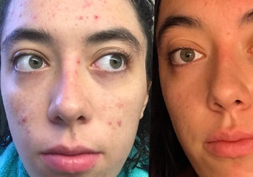 Retinoids: A Comprehensive Guide to Acne Treatment
